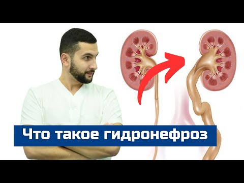 Видео: Гидронефроз: симптомы, диагностика и лечение