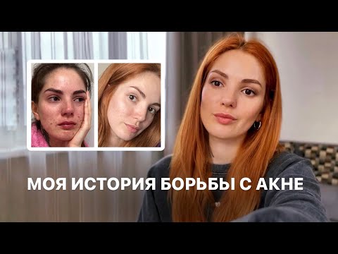 Видео: КАК Я ВЫЛЕЧИЛА ПРЫЩИ?! МОЯ ИСТОРИЯ С АКНЕ. МОЙ УХОД ЗА КОЖЕЙ