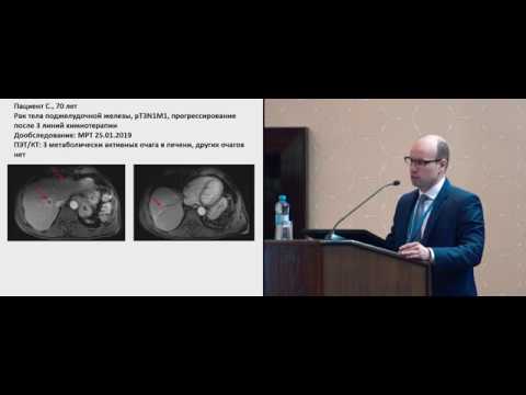 Видео: Лечение больных метастатическим РПЖ. Клинический случай 1