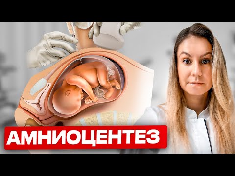 Видео: Амниоцентез. ОСЛОЖНЕНИЯ после процедуры. ЗАЧЕМ нужно его делать?