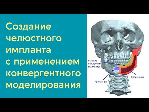 Видео: Процесс создания челюстного имплантата с применением конвергентного моделирования
