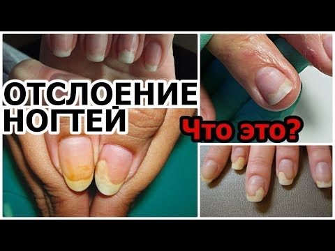 Видео: ОНИХОЛИЗИС (Отслоение ногтей): Причины, Диагностика, Устранение.