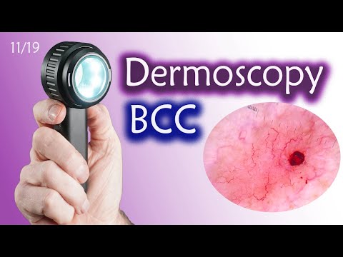 Видео: Дерматоскопия базальноклеточного рака [БКР]