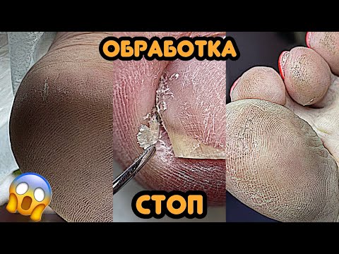 Видео: Педикюр обработка стоп 💅 Удаляем подногтевую мозоль / Летний матовый педикюр