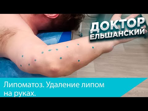 Видео: Липоматоз  Удаление липом на руках. Lipomatosis. Removal of lipomas of the arms.