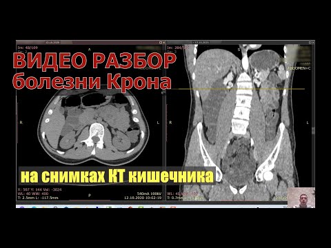 Видео: Видео разбор и оценка результатов КТ кишечника при атипичной болезни Крона после КТ расшифровки