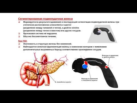 Видео: УЗИ. Доктор Иогансен. Выпуск 47. Аномалии развития поджелудочной железы. Часть 2.