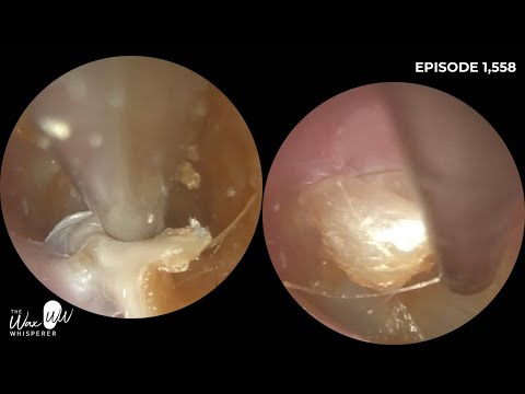 Видео: 1558 слоёв омертвевшей кожи удалены с уха (часть 2)