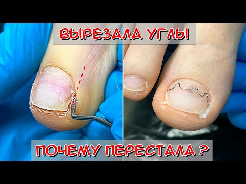 Видео: Педикюр в домашних условиях / Болят ногти на ногах