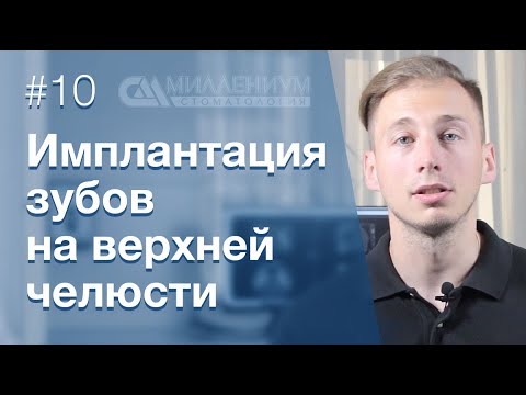 Видео: Имплантации зубов на верхней челюсти