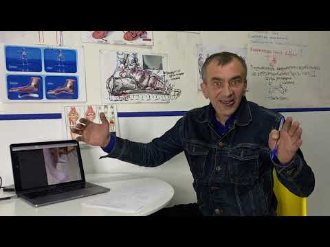 Видео: 3 стадия продольно поперечного плоскостопия, х - образность, косточки, молоткообразные пальцы.