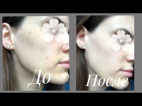 Видео: Пилинг Джесснера. 🔝 Пилинг как в салоне за копейки. 🌸 Чистая кожа лица.