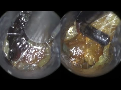 Видео: 35 - Комплексное удаление ушной серы с помощью WAXscope®️