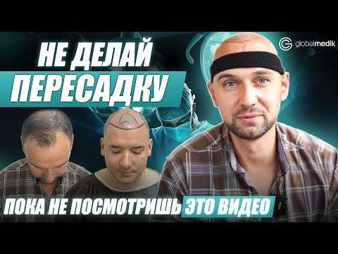 Видео: Как проходит пересадка волос в Стамбуле? Реальные истории двух пациентов. Метод DHI