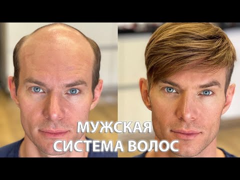 Видео: Алопеция у мужчин. Накладка из волос. До и после