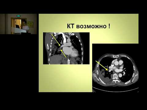 Видео: Тромбоэмболия легочной артерии ТЭЛА  Kошкина Е.В.