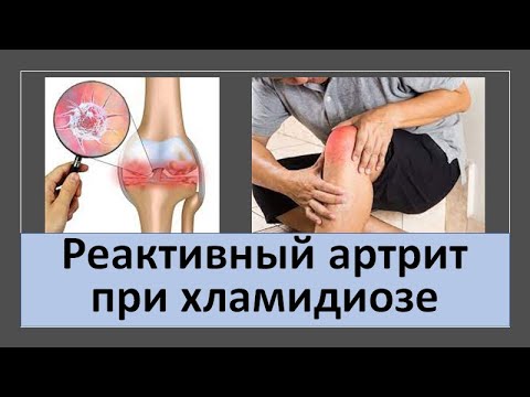 Видео: Реактивный артрит при хламидиозе