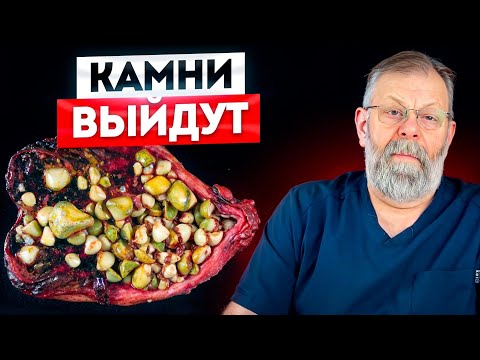 Видео: 🟨 КАМНИ В ЖЕЛЧНОМ - ВЫЙДУТ