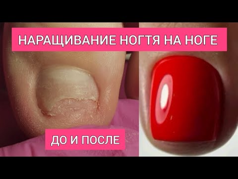 Видео: Онихолизис и наращивание ногтя | Пошагово: от обрезанного до идеального