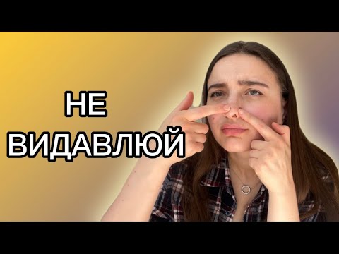 Видео: Все про ЗАКРИТІ КОМЕДОНИ, ЧОРНІ ЦЯТКИ та САЛЬНІ НИТІ.