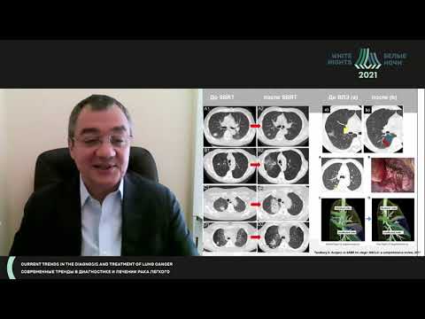Видео: Стереотаксическая лучевая терапия  – заменит хирургию при 1 стадии «Нет»