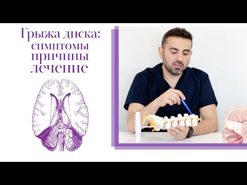 Видео: Грыжа поясничного отдела позвоночника: симптомы, причины, лечение