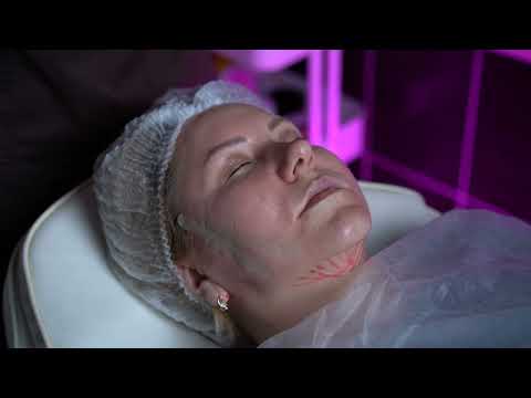 Видео: Восходящий лифтинг лиза. Мезонити. Коги