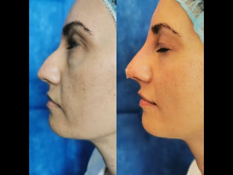 Видео: Изправяне на нос с резорбируеми конци