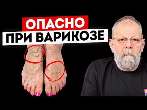 Видео: Что нельзя делать при варикозе? Доктор медицинских наук.