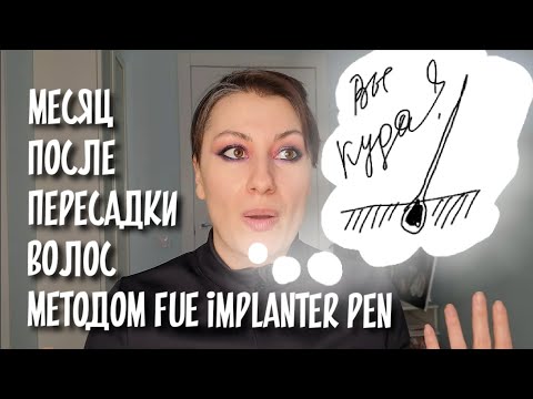 Видео: АЛОПЕЦИЯ| 1 месяц после пересадки волос методом FUE Implanter Pen в Спб | шоковое выпадение и зуд