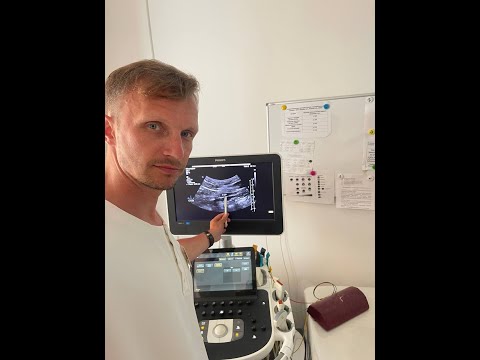 Видео: Как найти камень средней трети мочеточника?