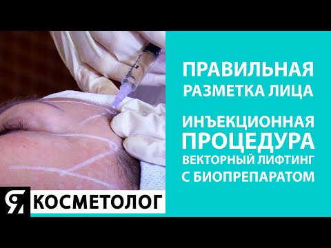 Видео: Правильная разметка лица. Инъекционная процедура «Векторный Лифтинг» с биопрепаратом CURACEN