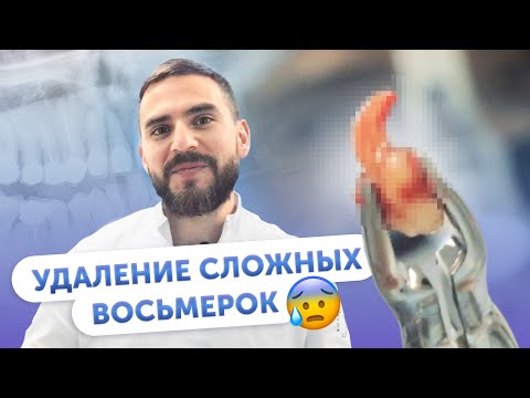 Видео: Удаление сложных зубов мудрости