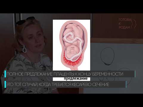 Видео: О низкой плацентации и расположении плаценты