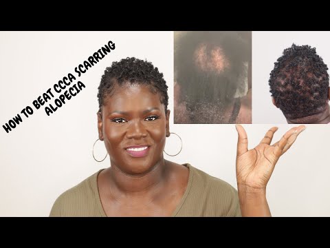 Видео: 5 вещей, которые действительно помогают при CCCA или рубцовой алопеции