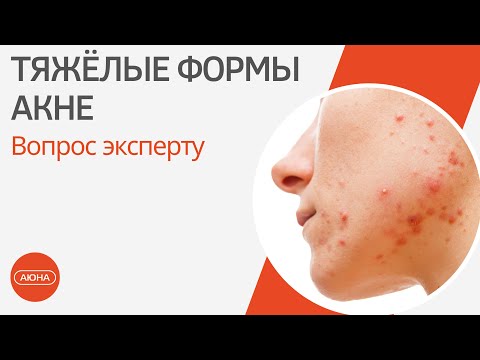 Видео: Тяжелые формы акне: вопрос эксперту