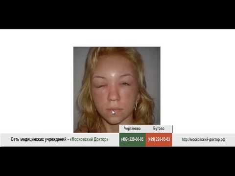 Видео: Что делать, если возникает отек Квинке