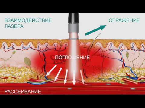 Видео: Лазер высокой интенсивности BTL-6000 HIL. Особенности технологии и медицинские эффекты.