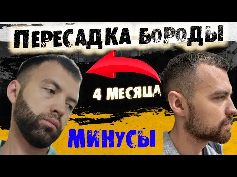 Видео: Посмотри это видео пока не сделал ПЕРЕСАДКУ БОРОДЫ / Андрей Борода Выпуск №30