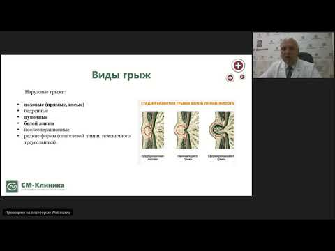 Видео: Вебинар "Грыжи белой линии живота" – Сенько.В.В.