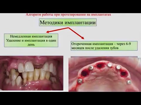 Видео: Все ТОНКОСТИ протезирования на имплантатах: основы взаимодействия ортопеда и хирурга. Арам Давидян