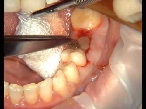 Видео: Лечение альвеолита с помощью Clot-PRF. Treatment of alveolitis with Clot-PRF.