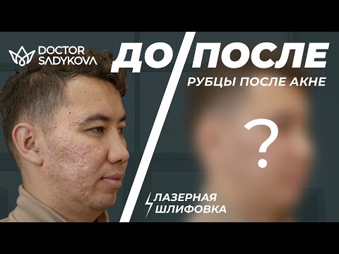 Видео: ЛАЗЕРНАЯ ШЛИФОВКА CO2: ГЛАДКАЯ КОЖА БЕЗ РУБЦОВ И ПОСТАКНЕ
