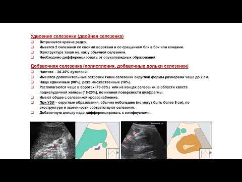 Видео: Ультразвуковая диагностика (УЗИ). Доктор Иогансен. Выпуск 60. Аномалии развития селезенки.