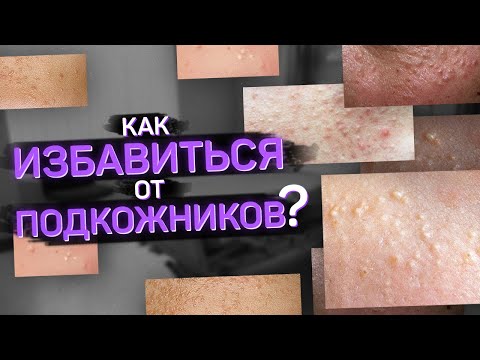 Видео: Подкожники. Что такое и как от них избавиться?