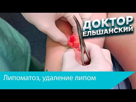 Видео: Липоматоз, удаление липом