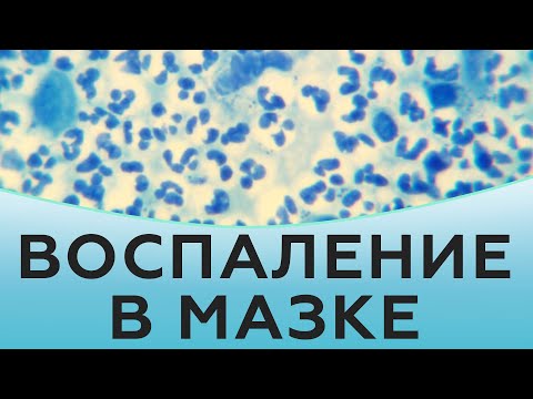 Видео: Воспаление в мазке