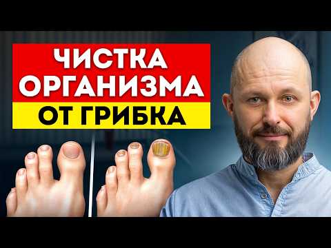 Видео: НЕ ПРОПУСТИТЕ симптомы грибковой инфекции! / Как обнаружить и вылечить грибок на ногах?
