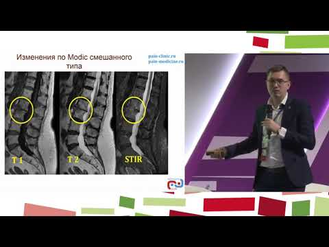 Видео: "Modic changes - Дорсопатии по Модику. Что это и что с этим делать"