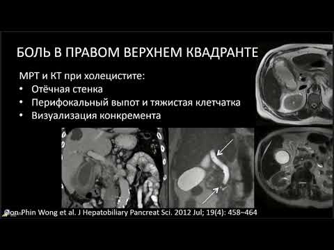 Видео: Острый живот выбор метода лучевой диагностики